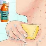 Put Apple Cider Vinegar on Your Face And See What Happens to Toxins, Eczema and Age Spots