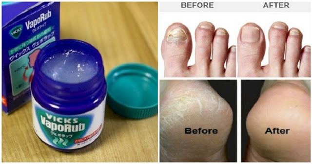 How To Use Vicks VapoRub in 11 Unique Ways