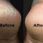 Grandma Told Me This Trick. It Healed My Cracked Heels In Just 1 Night